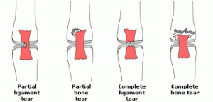 ligamen lutut koyak